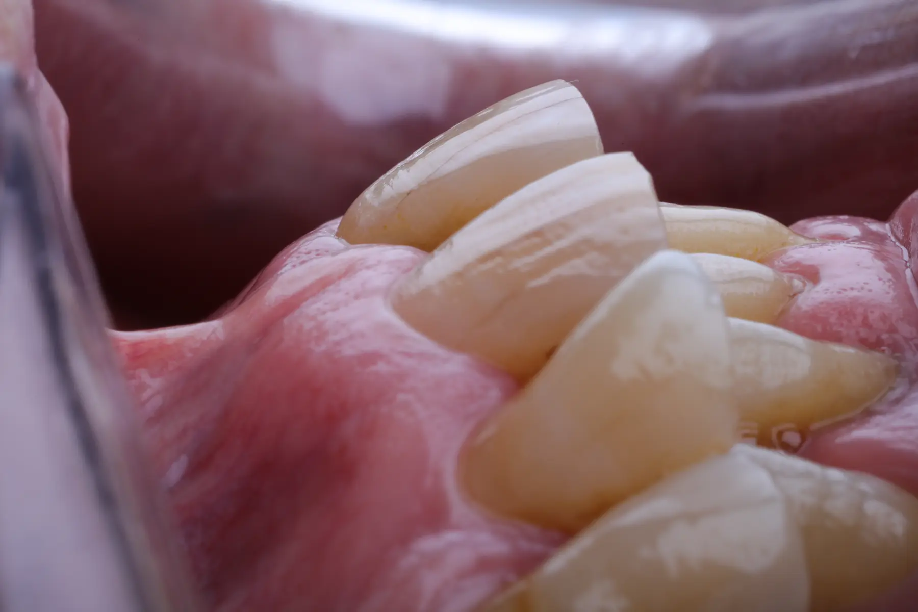 Primer plano de una rehabilitación sobre implantes terminada