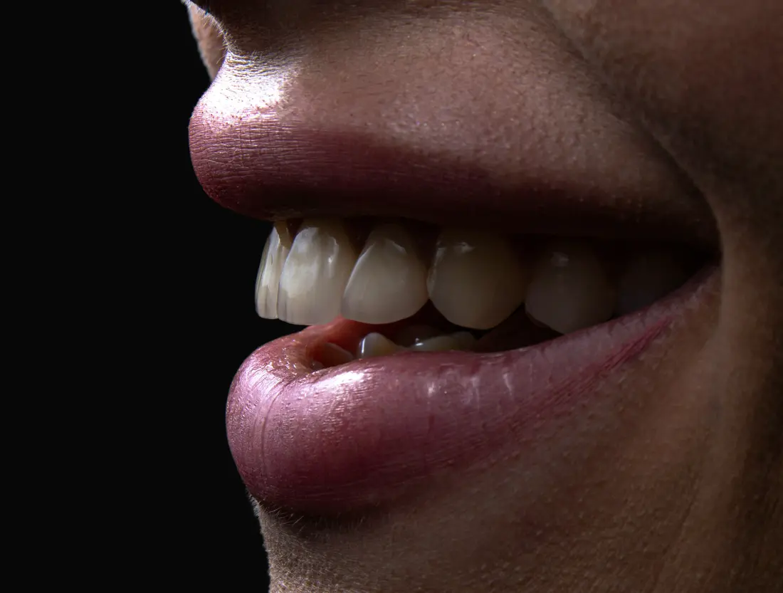 Resultado estético de una rehabilitación sobre implantes